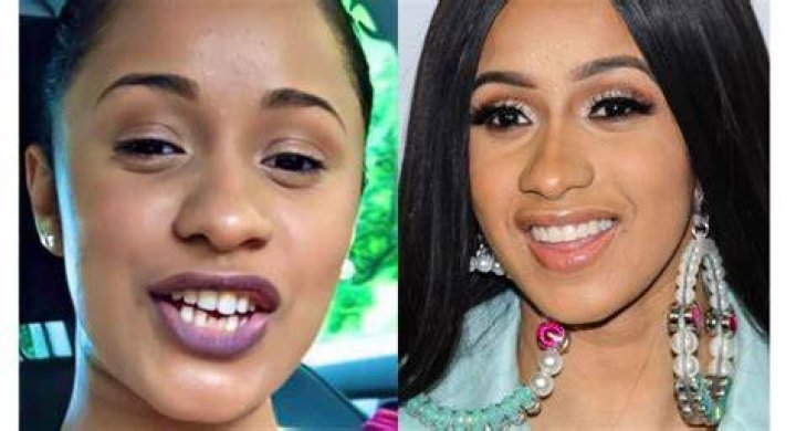 Cardi B Teeth Before And After Old Smile Vs New Empire BBK