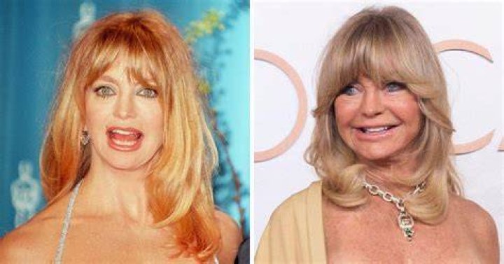 Did Goldie Hawn Resort To Plastic Surgery? The Answers You Seek