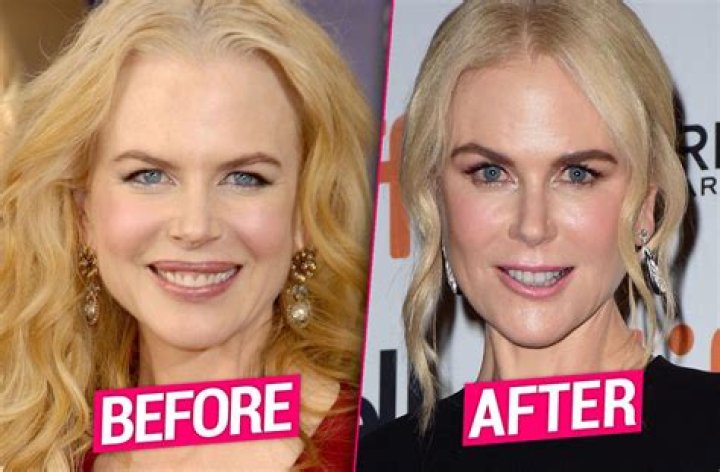Did Nicole Kidman Have Facelift & Lip Augmentation?