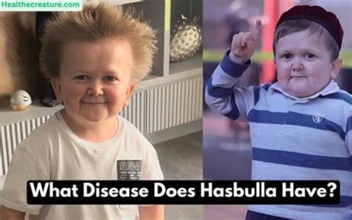 Hasbulla Disease What Is Hasbulla Condition? What Disorder Does
