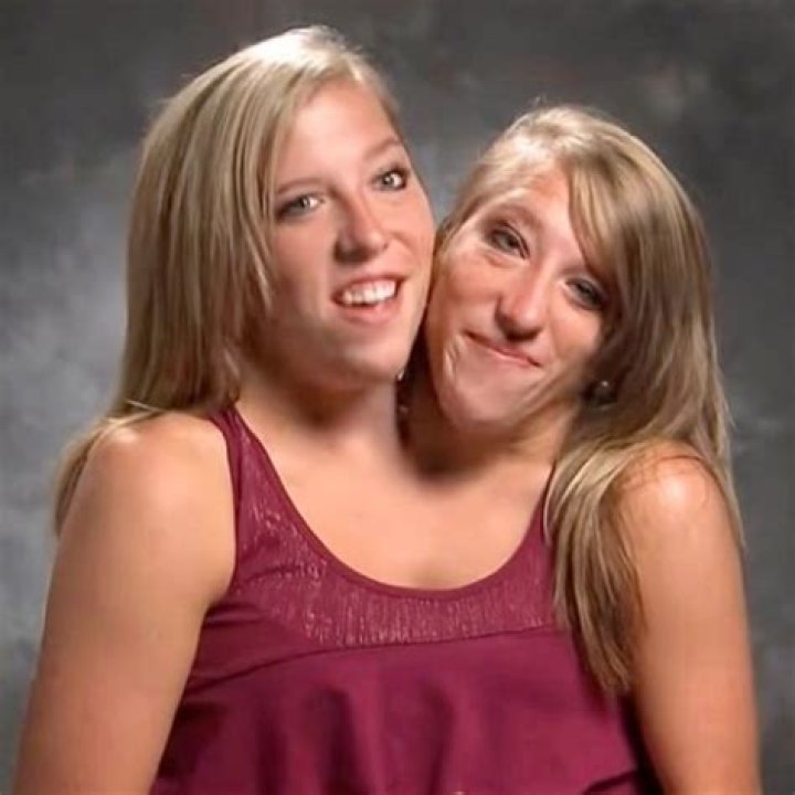 Here’s What Conjoined Twins Abby And Brittany Hensel Look Like Today