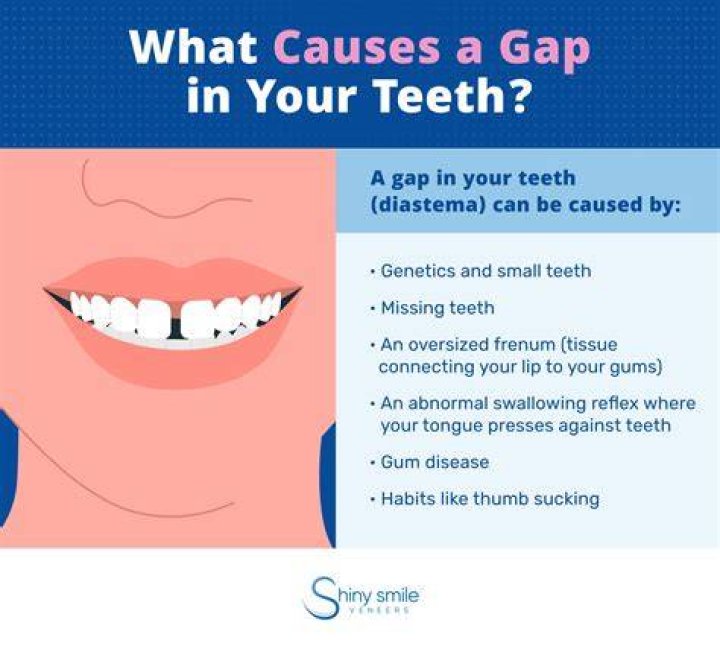 Tooth Gap Where does the gap between the teeth come from?